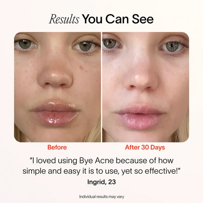 3-Minute Pimple Spot Treatment