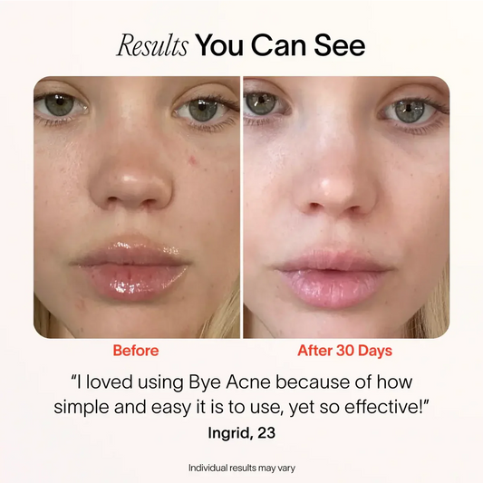 3-Minute Pimple Spot Treatment