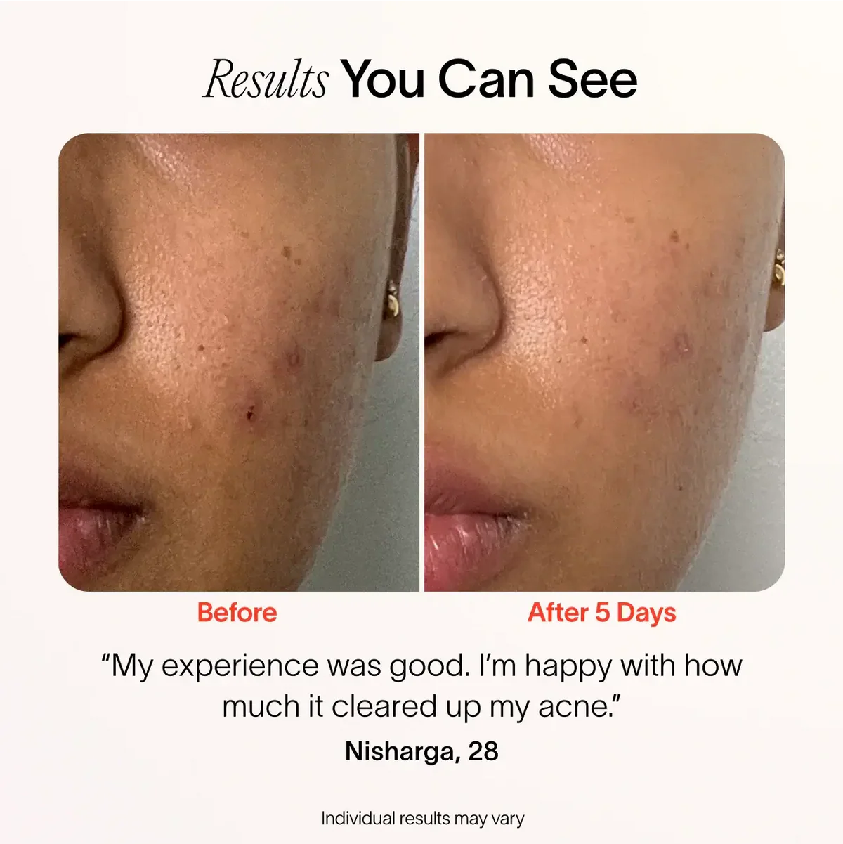 3-Minute Pimple Spot Treatment