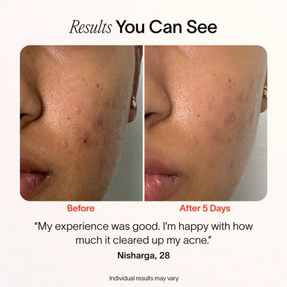 3-Minute Pimple Spot Treatment
